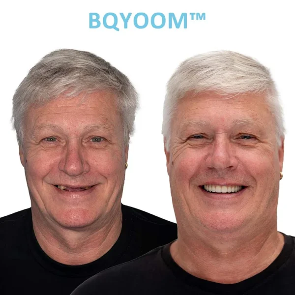 BQYOOM™ GelFit Dentures