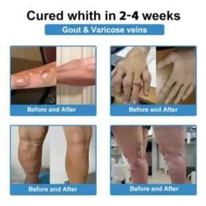 Skavix® Nano-Microneedle Joint Patch