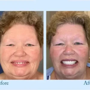 Smileasego™ – Premium-Zahnprothese