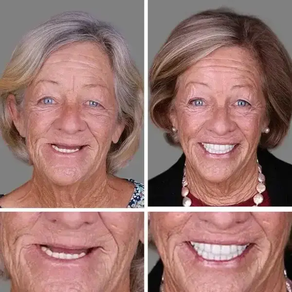 🌎Ends Today: 70% OFF! ⏰ Medical Full Denture with Strong Suctiond