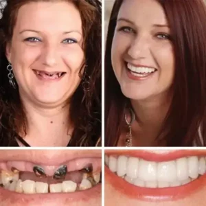 🌎Ends Today: 70% OFF! ⏰ Medical Full Denture with Strong Suctiond