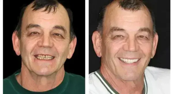 HZA™ Advanced Customized Full Denture Set