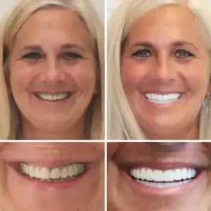 HZA™ Advanced Customized Full Denture Set
