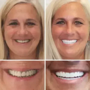 HZA™ Advanced Customized Full Denture Set